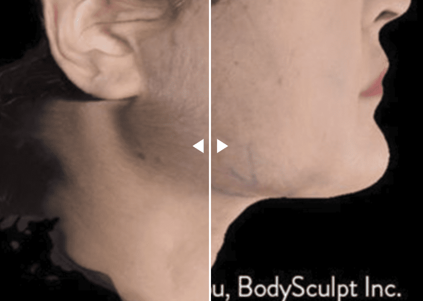 Screenshot 2024-11-28 at 5.13.50 PM ACCUTITE Before and After Pictures Jacksonville, FL